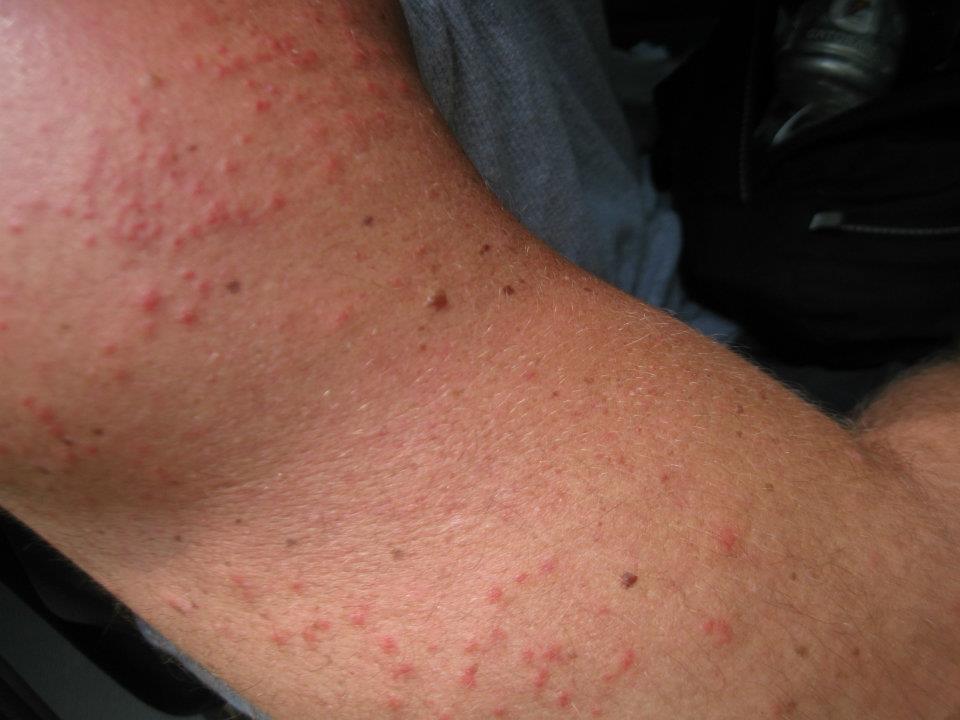 First Aid for Sand Fly Bites Choose Adventure